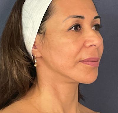 Facelift Before & After Gallery - Patient 141112618 - Image 4