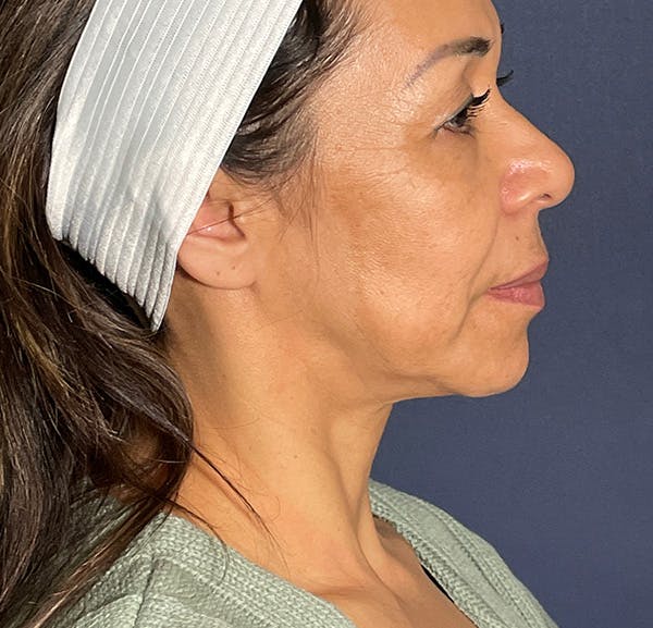 Neck Lift Before & After Gallery - Patient 141112678 - Image 5