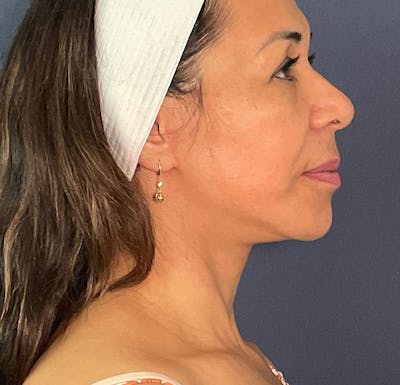 Neck Lift Before & After Gallery - Patient 141112678 - Image 6