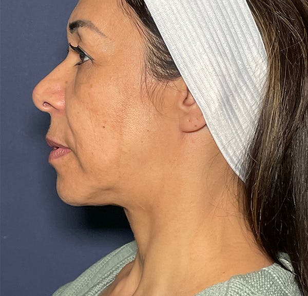 Neck Lift Before & After Gallery - Patient 141112678 - Image 7