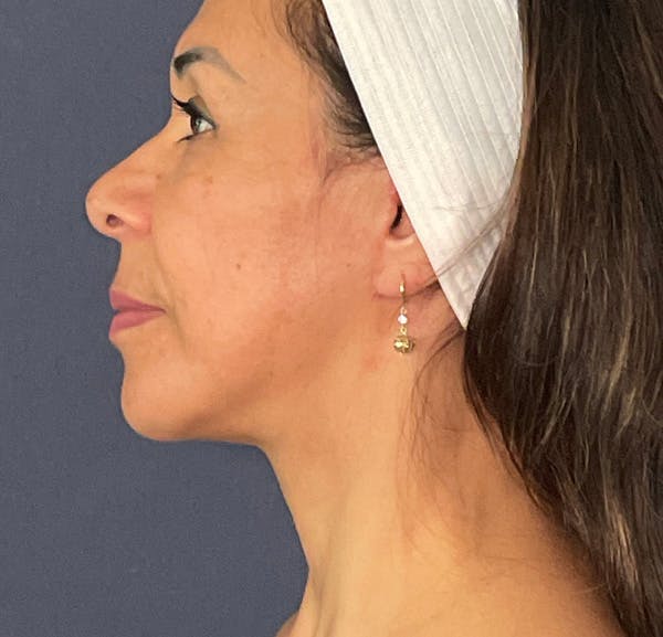 Neck Lift Before & After Gallery - Patient 141112678 - Image 8