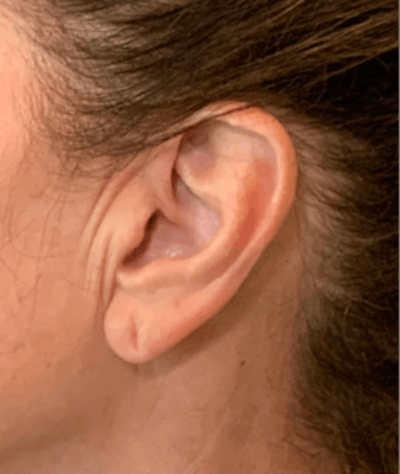 Ear Repair Before & After Gallery - Patient 141112747 - Image 1