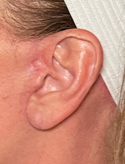 Ear Repair Before & After Gallery - Patient 141112747 - Image 2