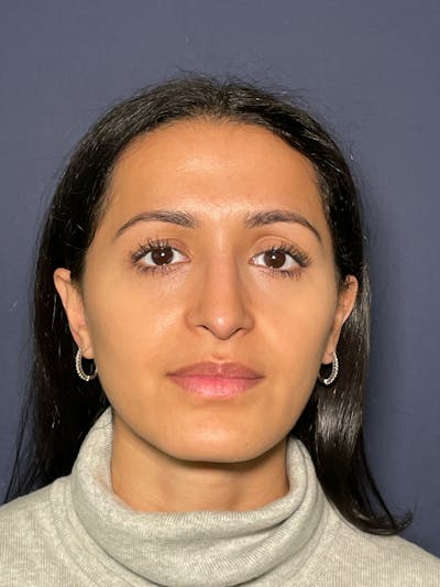 Rhinoplasty Before & After Gallery - Patient 52519316 - Image 2