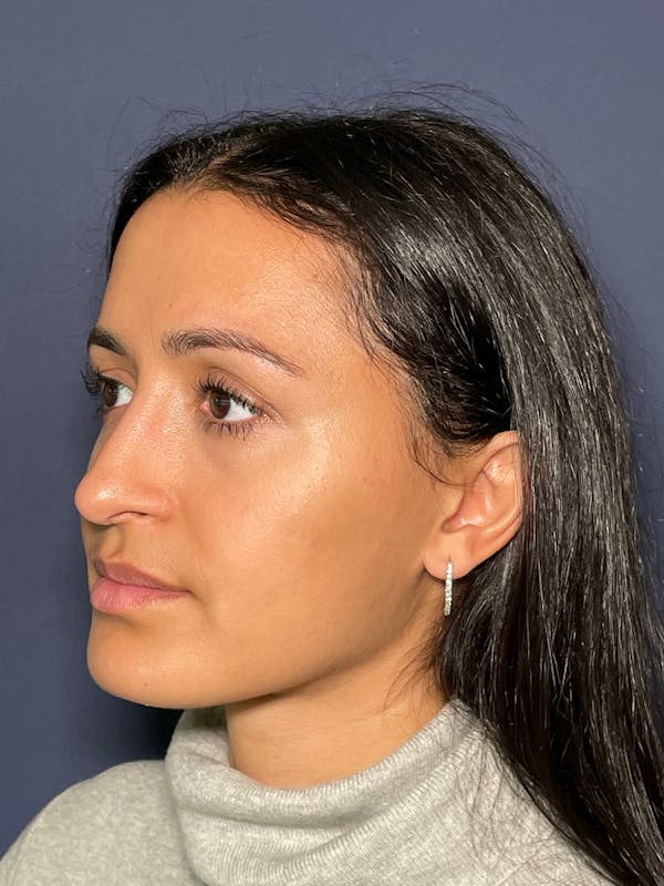 Rhinoplasty Before & After Gallery - Patient 52519316 - Image 4
