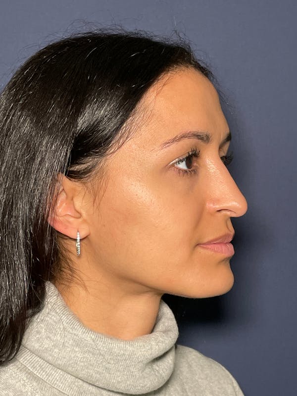 Rhinoplasty Before & After Gallery - Patient 52519316 - Image 8