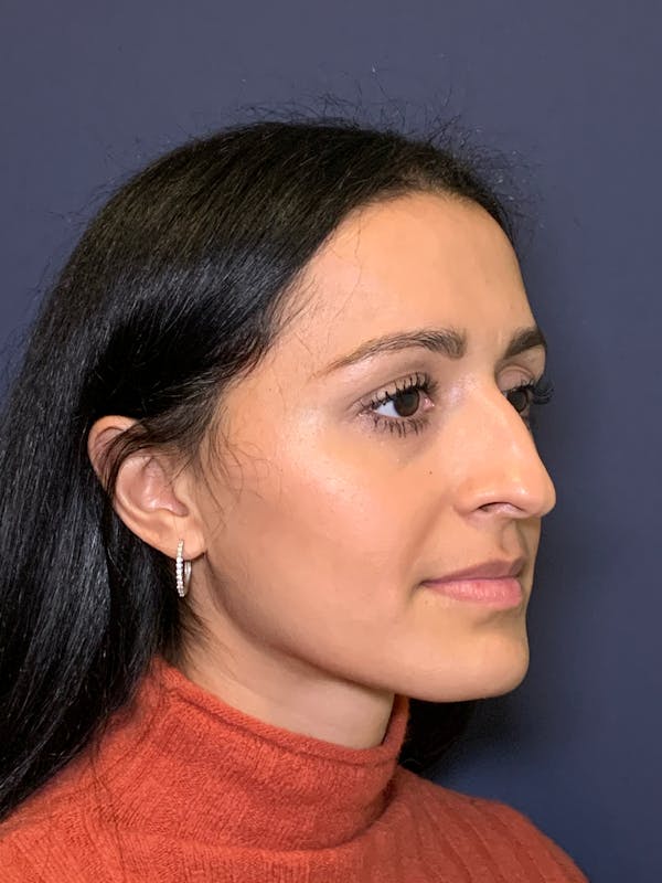 Rhinoplasty Before & After Gallery - Patient 52519316 - Image 7