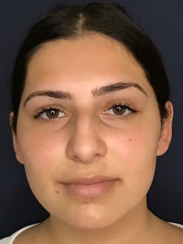 Rhinoplasty Before & After Gallery - Patient 13825962 - Image 1