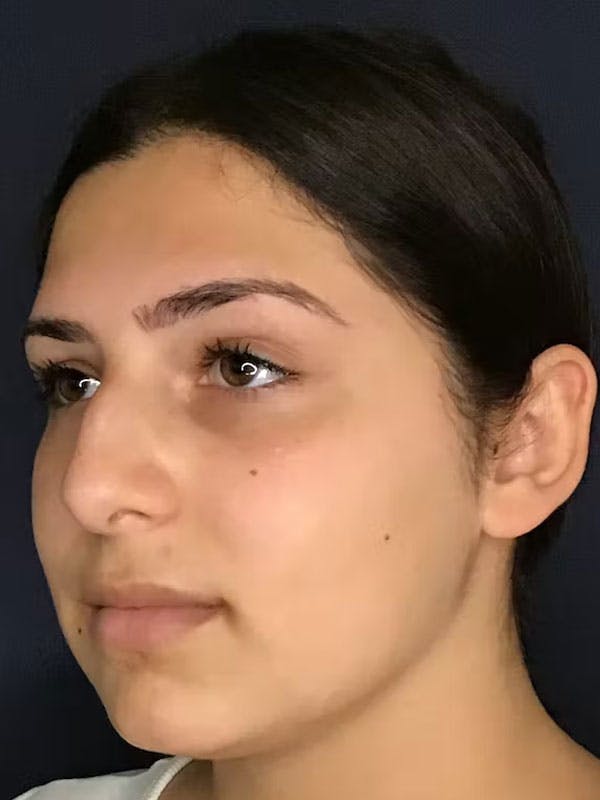 Rhinoplasty Before & After Gallery - Patient 13825962 - Image 3