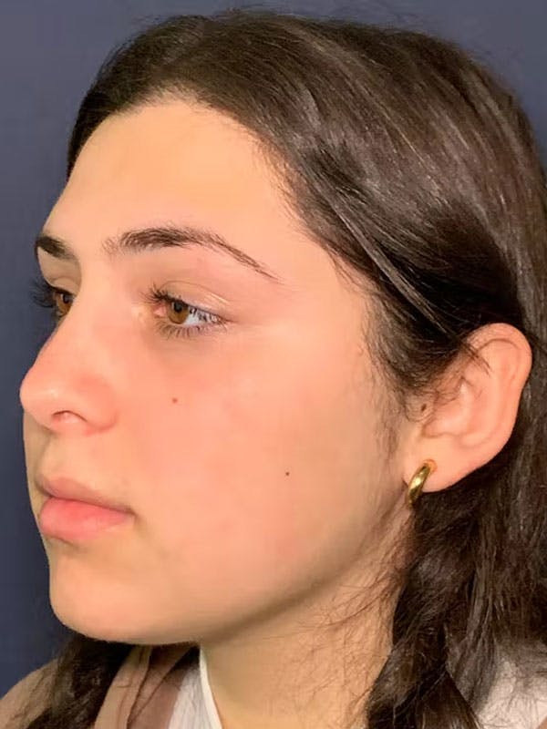 Rhinoplasty Before & After Gallery - Patient 13825962 - Image 4