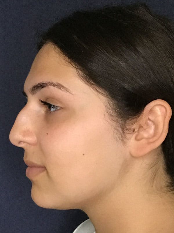 Rhinoplasty Before & After Gallery - Patient 13825962 - Image 5