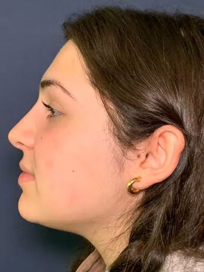 Rhinoplasty Before & After Gallery - Patient 13825962 - Image 6