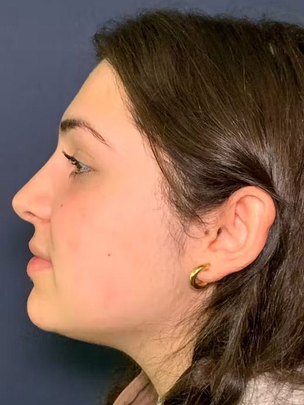 Rhinoplasty Before & After Gallery - Patient 13825962 - Image 6