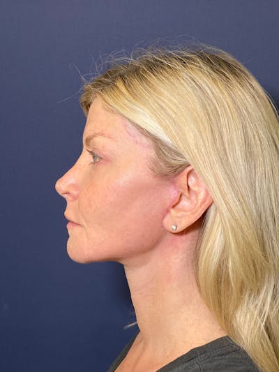 Neck Lift Before & After Gallery - Patient 141112692 - Image 6