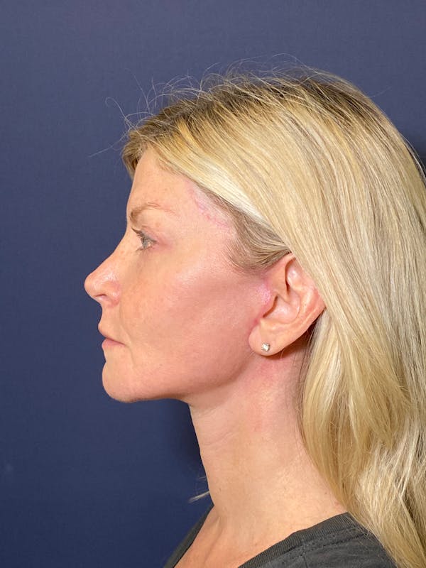 Facelift Before & After Gallery - Patient 53237660 - Image 6
