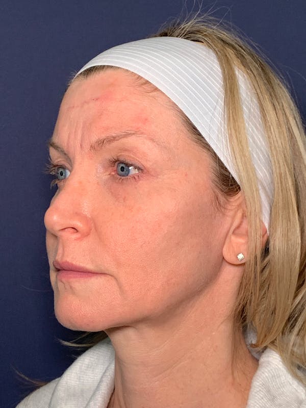 Facelift Before & After Gallery - Patient 53237660 - Image 3