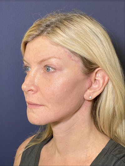 Neck Lift Before & After Gallery - Patient 141112692 - Image 4