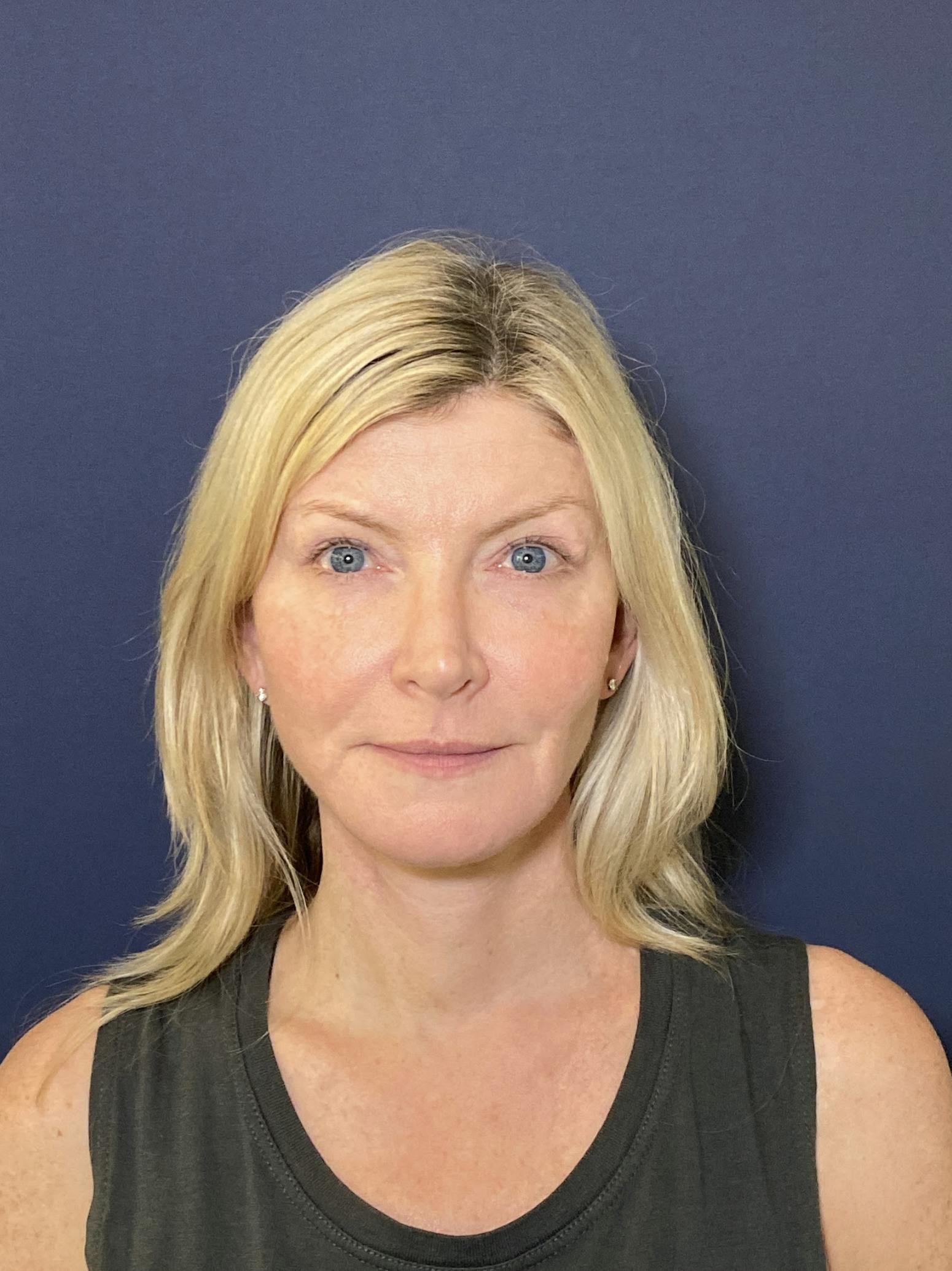 Facelift Before & After Gallery - Patient 53237660 - Image 2