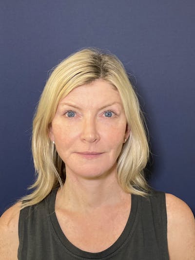 Neck Lift Before & After Gallery - Patient 141112692 - Image 2