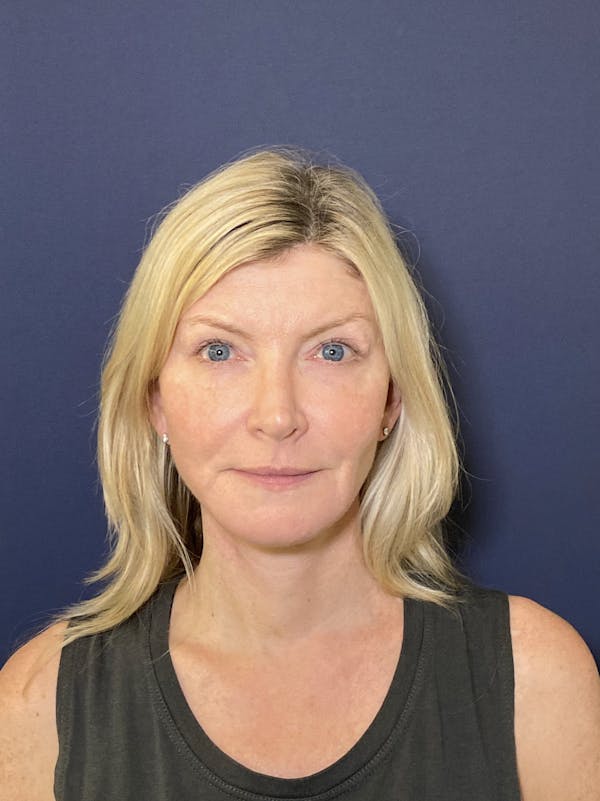 Neck Lift Before & After Gallery - Patient 141112692 - Image 2