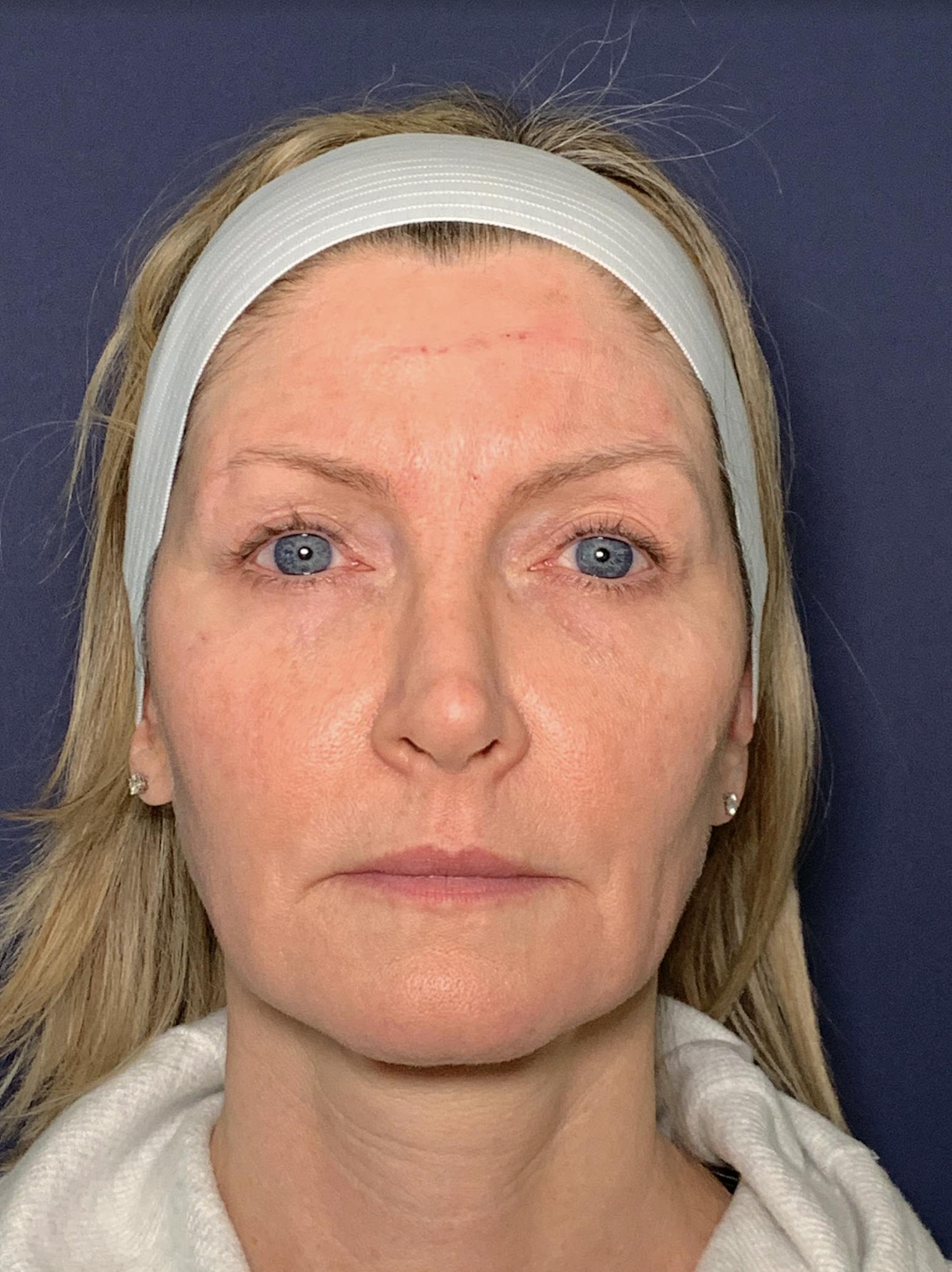 Facelift Before & After Gallery - Patient 53237660 - Image 1