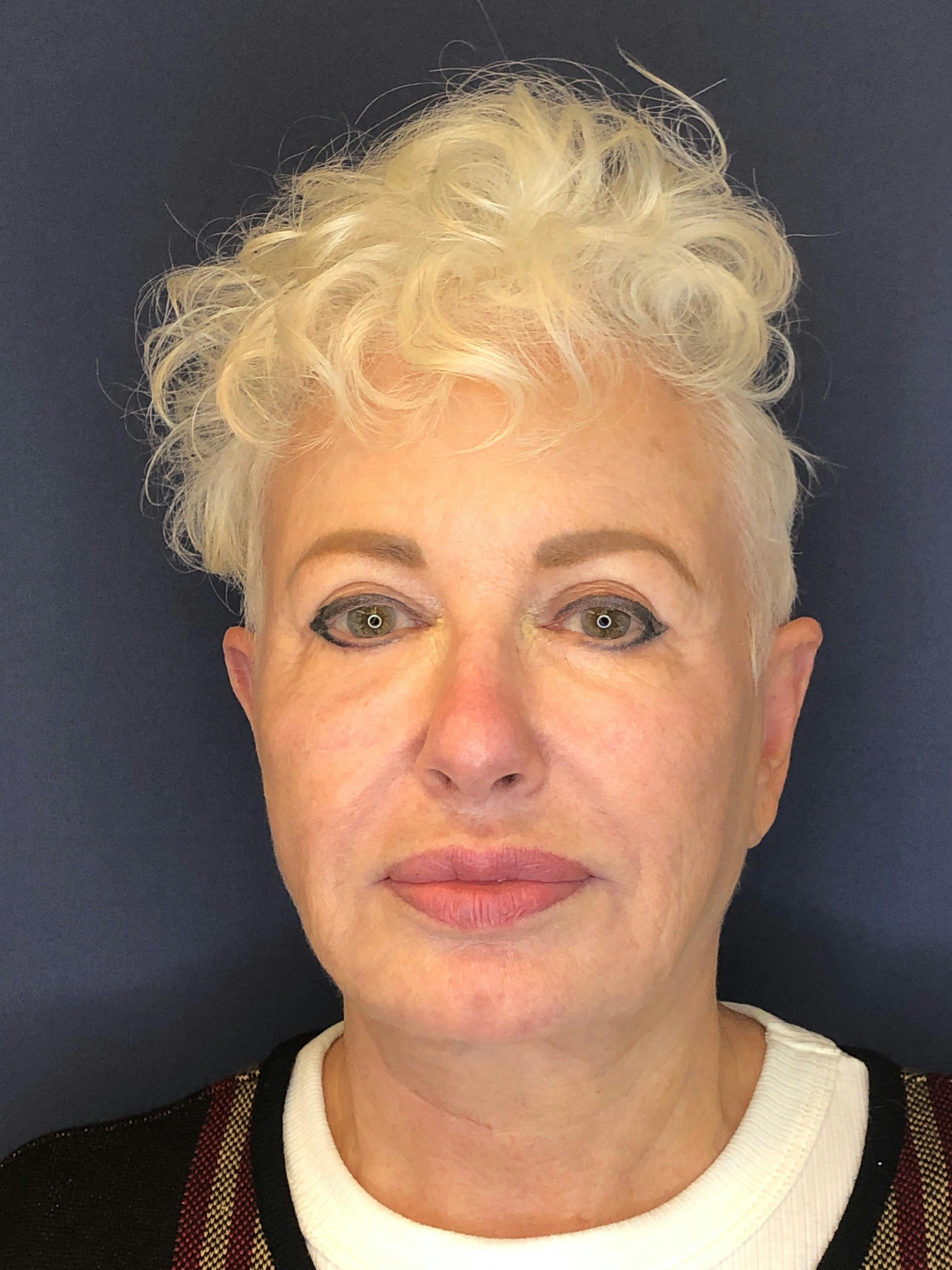 Facelift Before & After Gallery - Patient 53230537 - Image 1