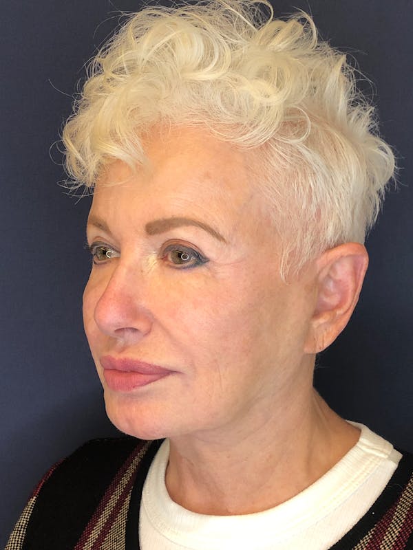 Neck Lift Before & After Gallery - Patient 141112690 - Image 3