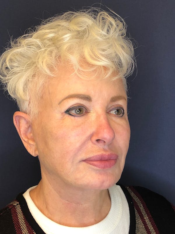Neck Lift Before & After Gallery - Patient 141112690 - Image 7