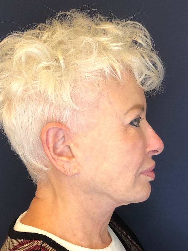 Neck Lift Before & After Gallery - Patient 141112690 - Image 9