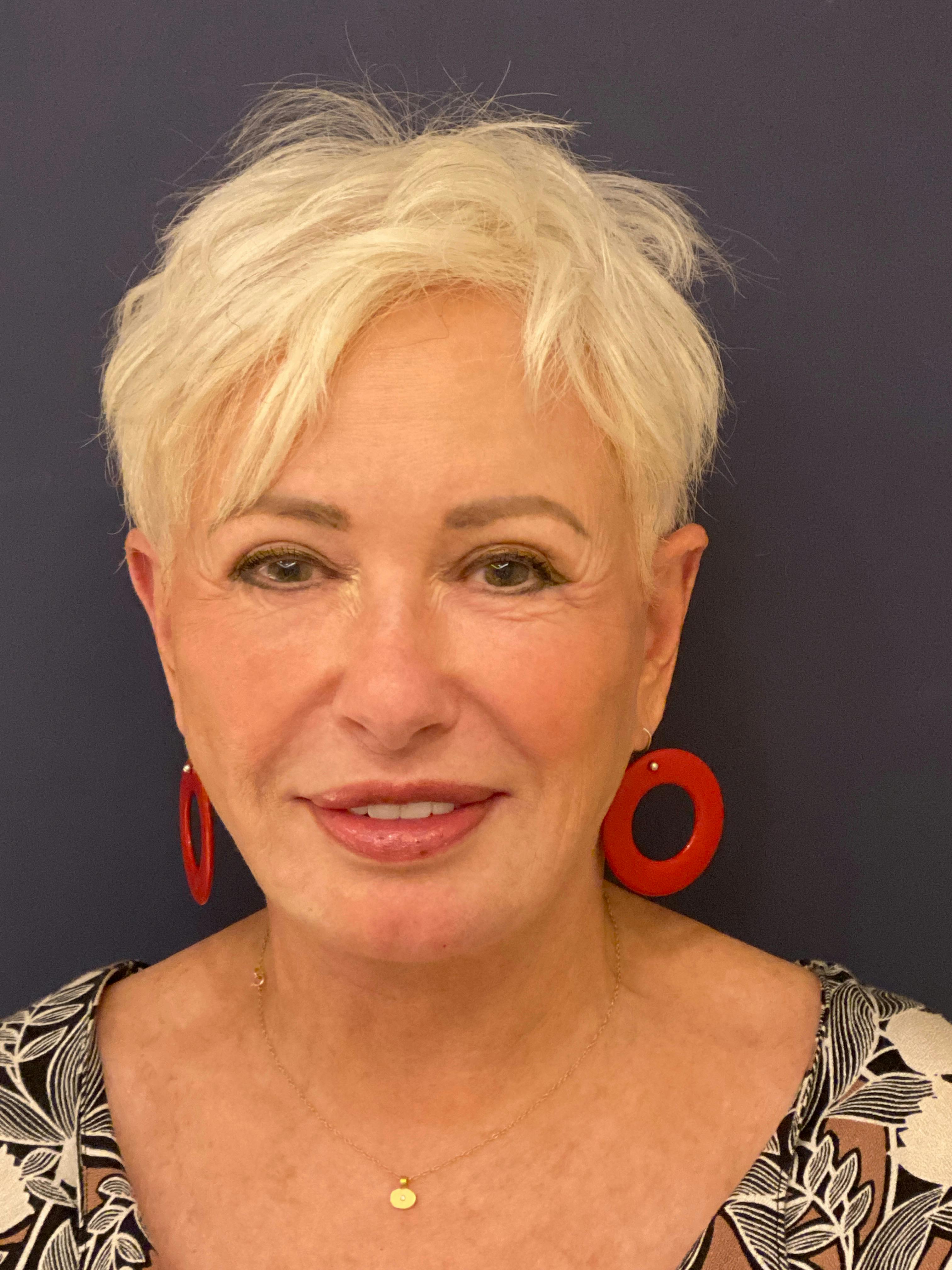 Facelift Before & After Gallery - Patient 53230537 - Image 2