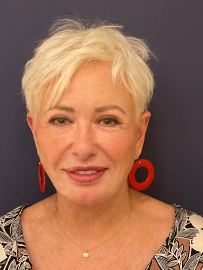 Neck Lift Before & After Gallery - Patient 141112690 - Image 2