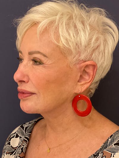 Neck Lift Before & After Gallery - Patient 141112690 - Image 4