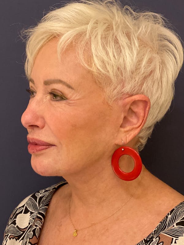 Neck Lift Before & After Gallery - Patient 141112690 - Image 4