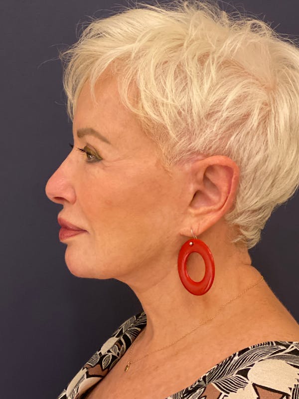 Neck Lift Before & After Gallery - Patient 141112690 - Image 6