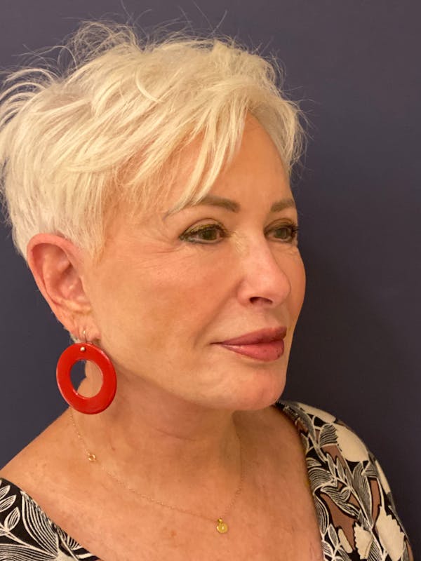 Neck Lift Before & After Gallery - Patient 141112690 - Image 8