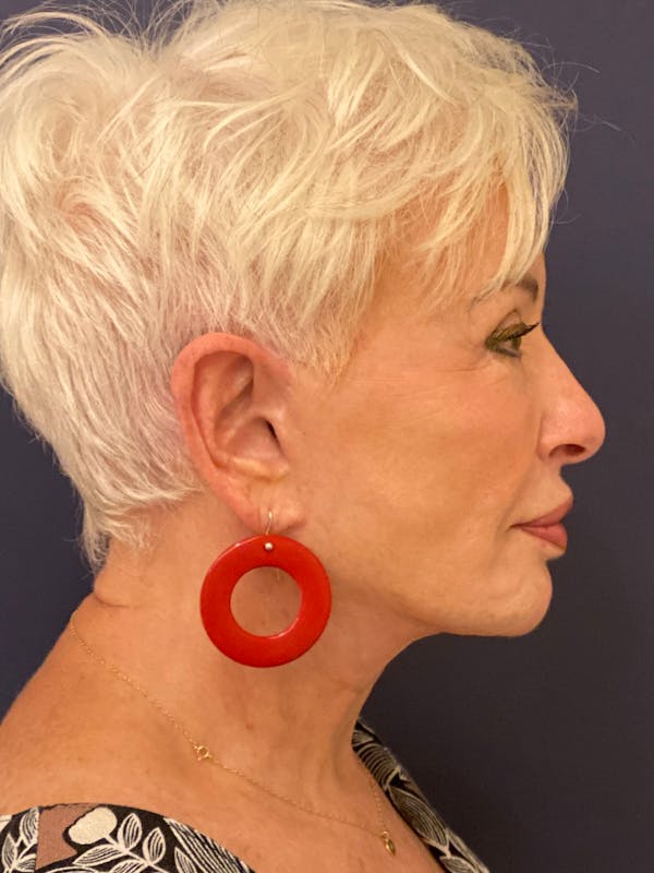 Neck Lift Before & After Gallery - Patient 141112690 - Image 10