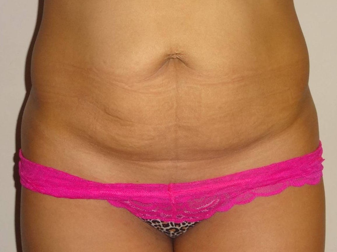 Liposuction Before & After Gallery - Patient 4452356 - Image 1