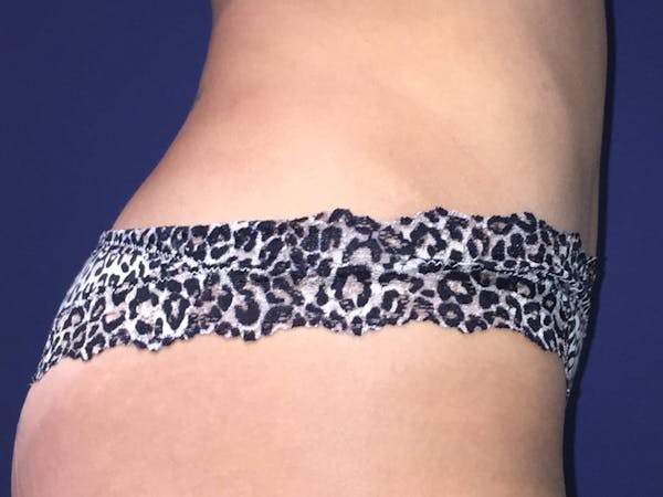 Liposuction Before & After Gallery - Patient 4452356 - Image 4