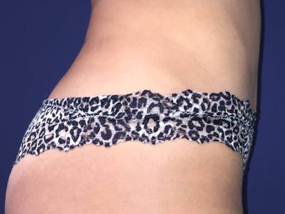 Liposuction Before & After Gallery - Patient 4452356 - Image 4