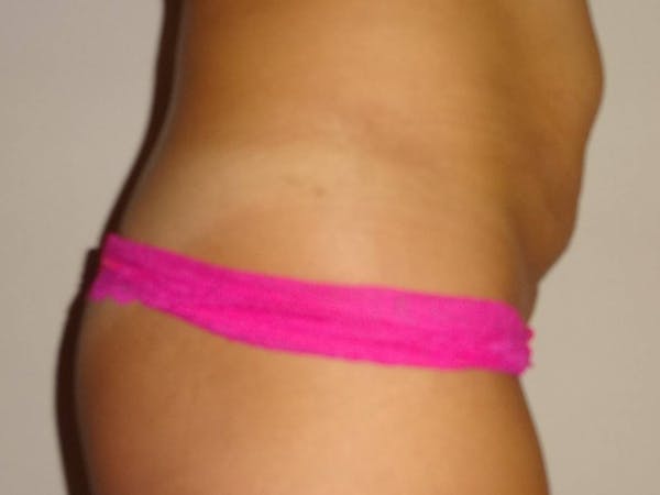 Liposuction Before & After Gallery - Patient 4452356 - Image 3