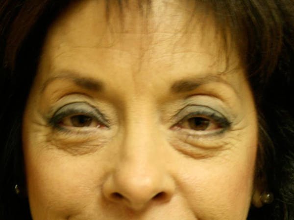 Blepharoplasty (Eyelid Surgery) Before & After Gallery - Patient 4447804 - Image 1