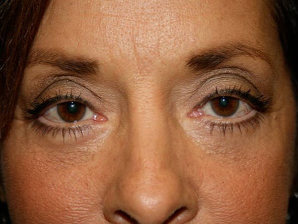 Blepharoplasty (Eyelid Surgery) Before & After Gallery - Patient 4447804 - Image 2