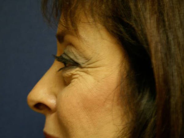 Blepharoplasty (Eyelid Surgery) Before & After Gallery - Patient 4447804 - Image 3