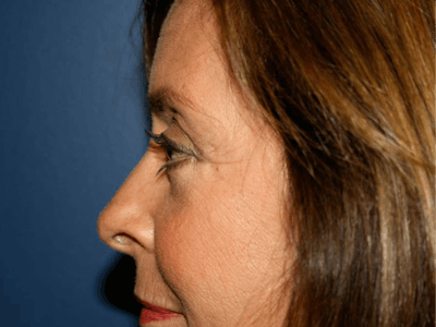 Blepharoplasty (Eyelid Surgery) Before & After Gallery - Patient 4447804 - Image 4