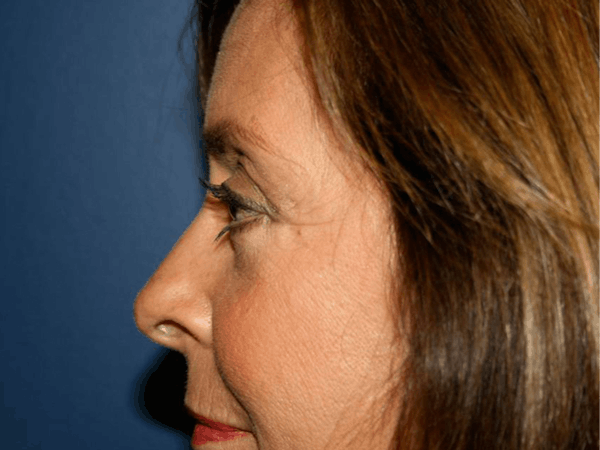 Blepharoplasty (Eyelid Surgery) Before & After Gallery - Patient 4447804 - Image 4