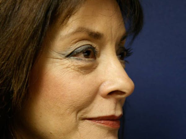 Blepharoplasty (Eyelid Surgery) Before & After Gallery - Patient 4447804 - Image 5