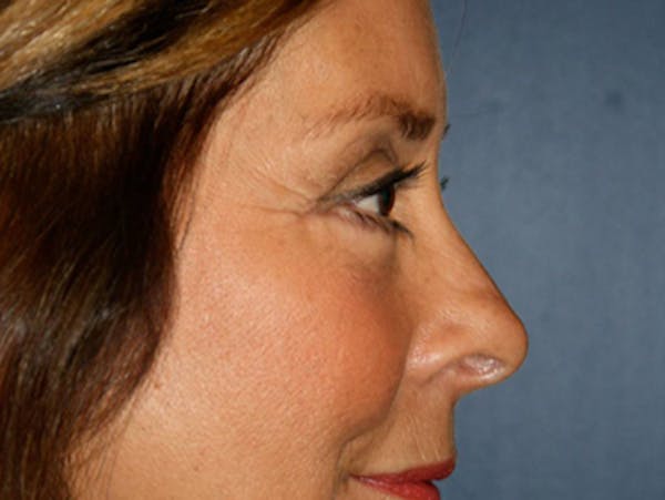 Blepharoplasty (Eyelid Surgery) Before & After Gallery - Patient 4447804 - Image 8