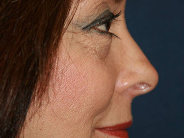 Blepharoplasty (Eyelid Surgery) Before & After Gallery - Patient 4447804 - Image 7