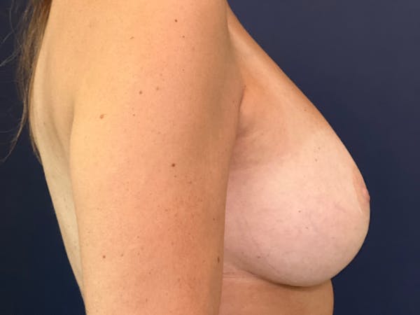 Breast Lift with Fat Grafting Before & After Gallery - Patient 141201547 - Image 6