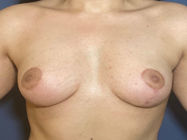 Breast Lift with Fat Grafting Gallery - Patient 117691818 - Image 2